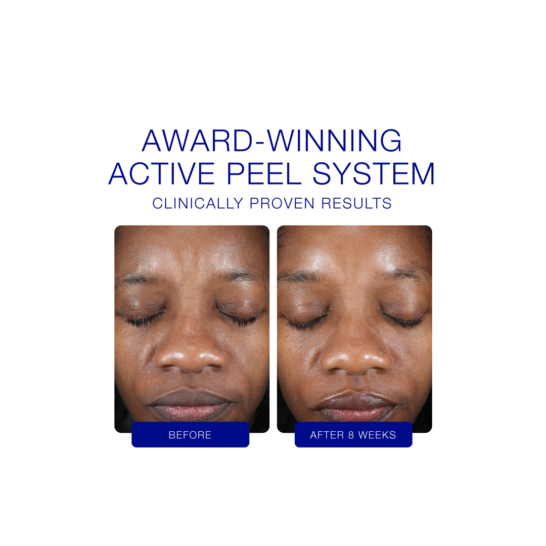 iS Clinical Active Peel Treatment System (30 Day Supply)