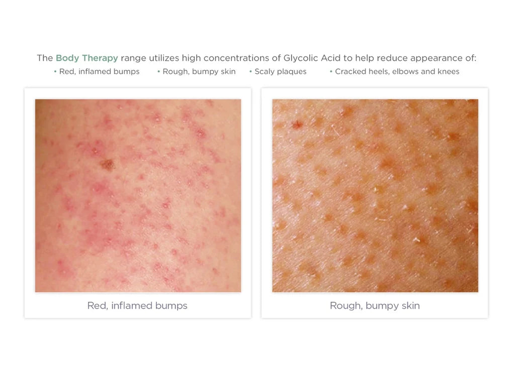 Glytone Exfoliating Body Lotion