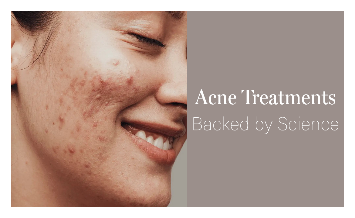 The Top Acne Solutions for Clear Skin