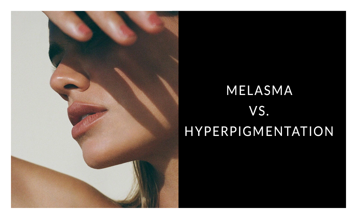 Melasma vs. Hyperpigmentation: Understanding the Difference for Healthier Skin