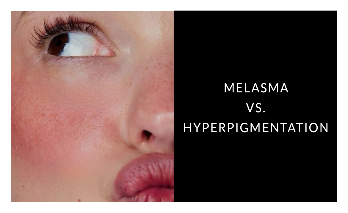 Melasma vs. Hyperpigmentation: Understanding the Difference for Healthier Skin