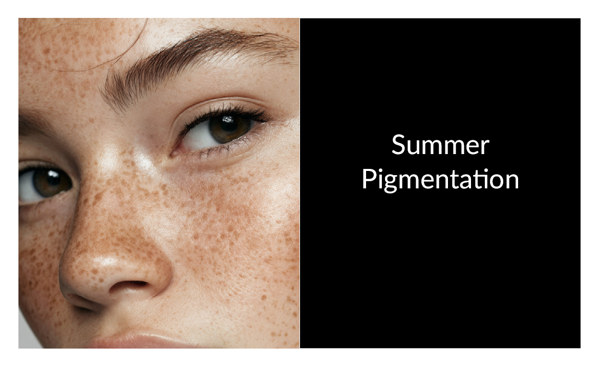Summer Skin & Dark Spots: Understanding UV-Induced Hyperpigmentation