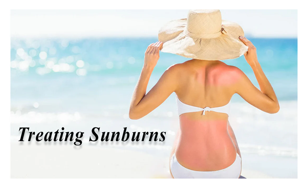 Understanding Sunburns: Facts and Prevention Tips