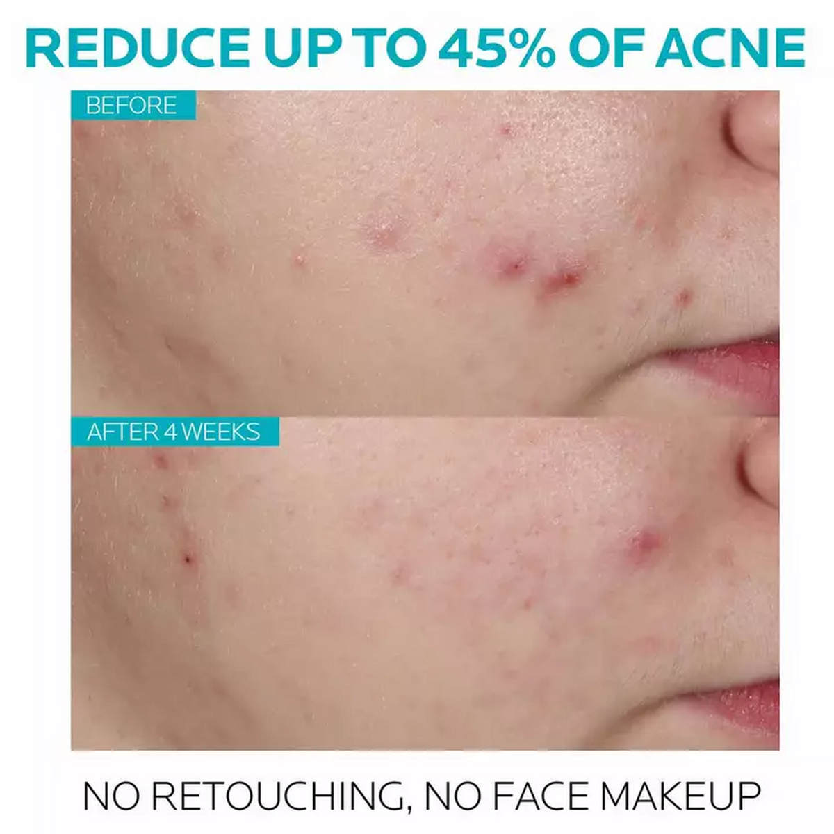 La Roche-Posay Effaclar Salicylic Acid Acne Treatment Serum