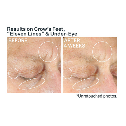 StriVectin Anti-Wrinkle Intensive Eye Concentrate For Wrinkles PLUS
