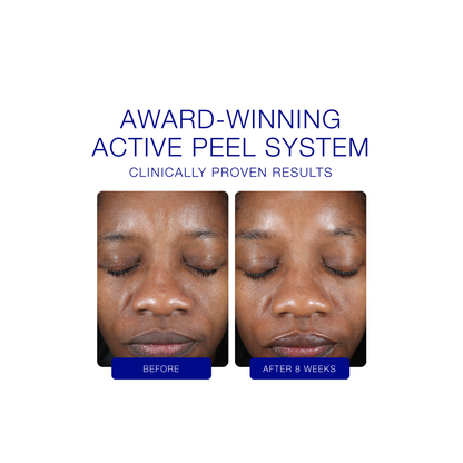 iS Clinical Active Peel Treatment System (30 Day Supply)