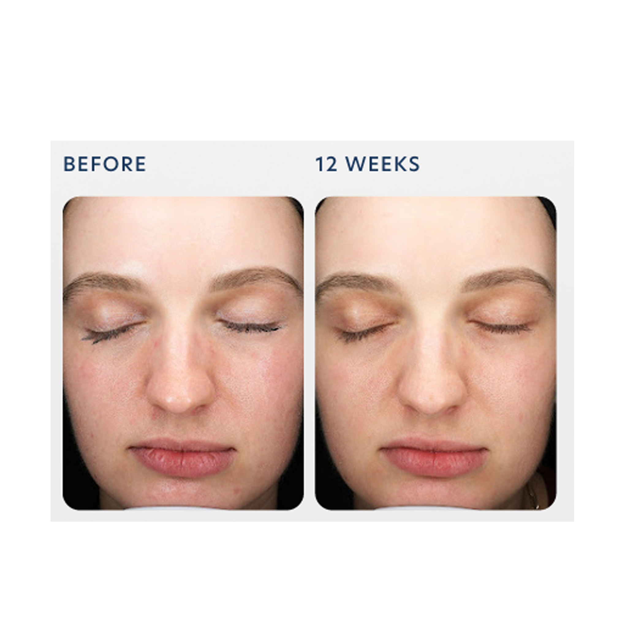 PCA Skin Triple Exfoliation Peel Pads