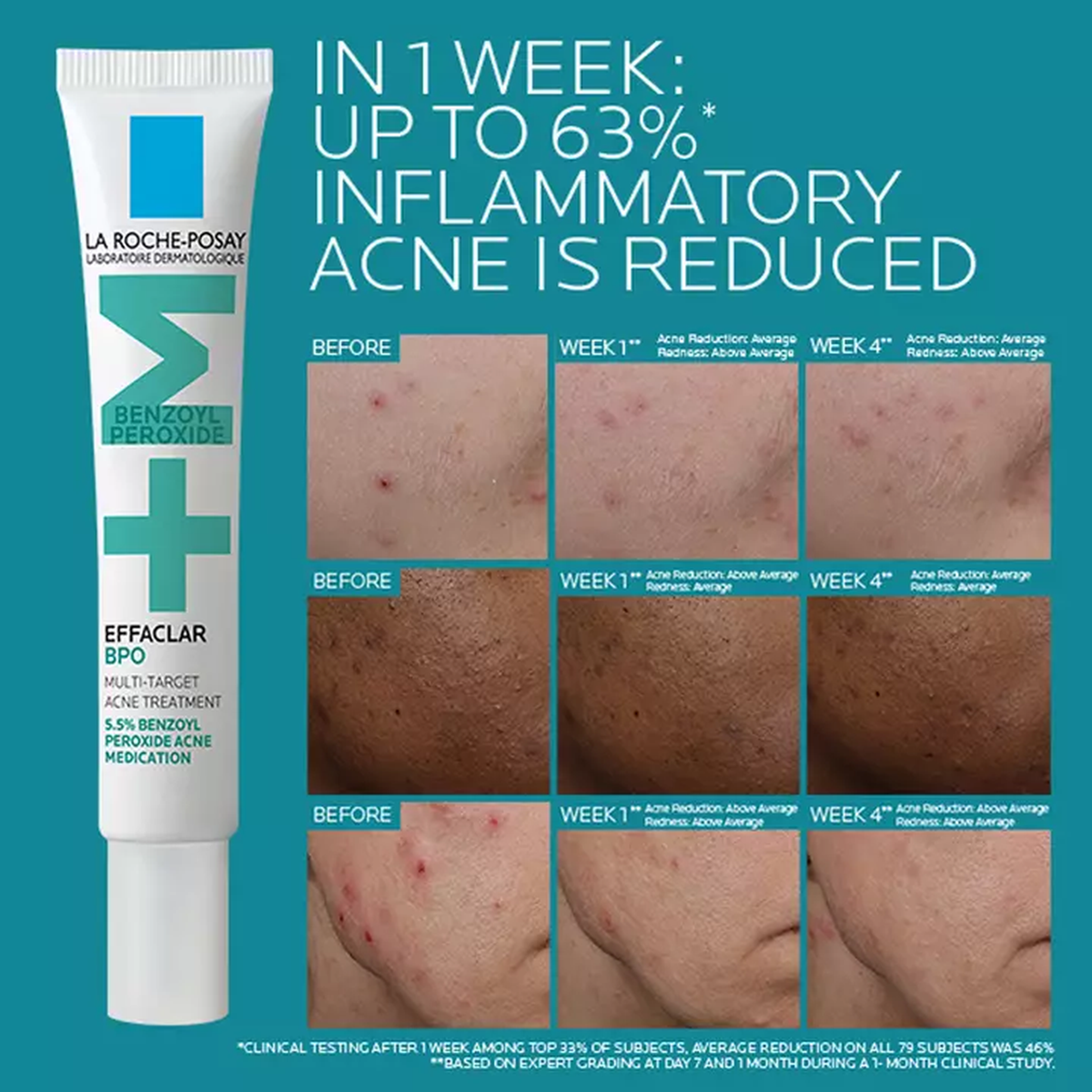 La Roche-Posay Effaclar BPO Multi-Target Acne Treatment with 5.5% Benzoyl Peroxide