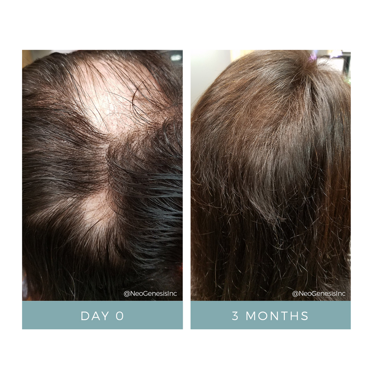 NeoGenesis Hair Thickening Serum 30 ml