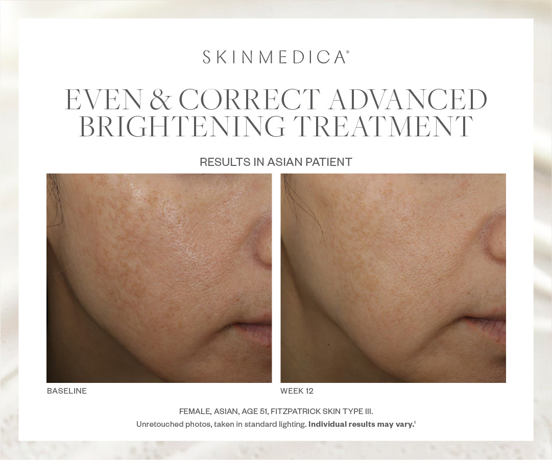 SkinMedica Even &amp; Correct Advanced Brightening Treatment Bundle